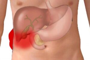 Πέτρα στη χολή επέμβαση