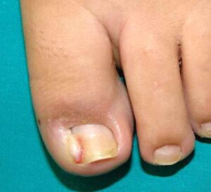 είσφρυση όνυχος πριν