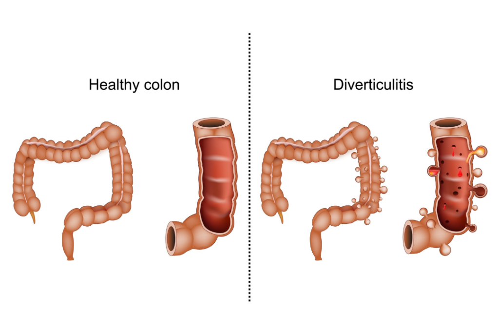 Εκκολπώματα εντέρου