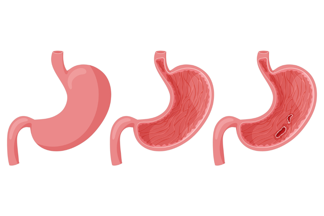 Έλκος στομάχου