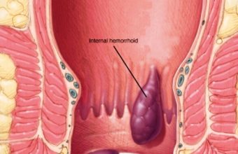 Αιμορροείδες