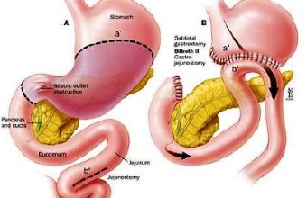 Διατροφικές Οδηγίες μετά από γαστρεκτομή