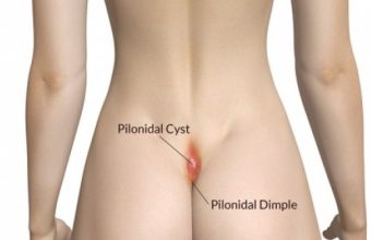 Κύστη Κοκκυγα