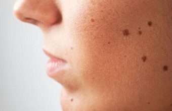 Σπίλοι - Ελιές στο σώμα