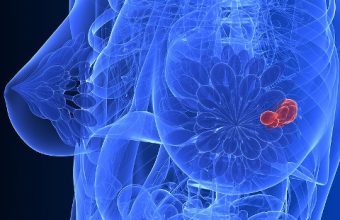 Χειρουργική Μαστού